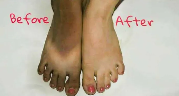feet tanning removal